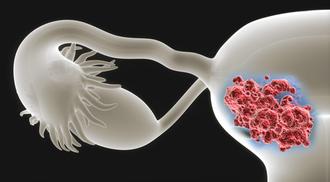 Perspective x-ray view of human uterus with endometrial cancer